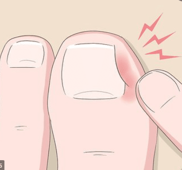 Alicate Para Desencravar Unhas + Kit Exclusivo đ Alicate PrĂłprio Para Desencravar unhas Casa Feita